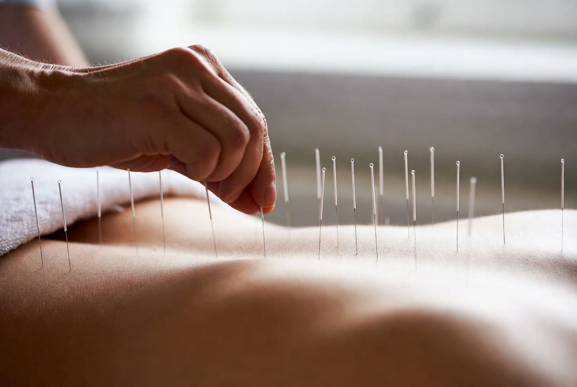 Пациент на сеансе иглоукалывания